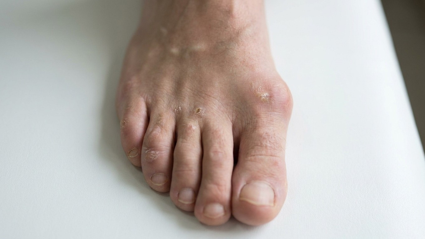 I sized my climbing shoes a full size down just for better edging: two years later, an X-ray showed what my big toe had be...